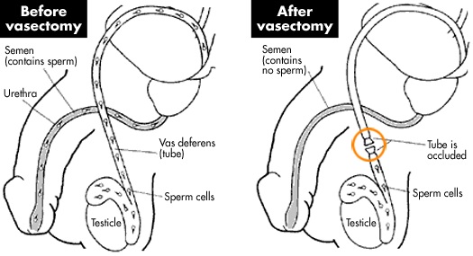 schema appareil génital de l'homme avant et apres vasectomie