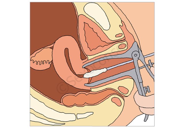 schéma du frottis cervical de dépistage