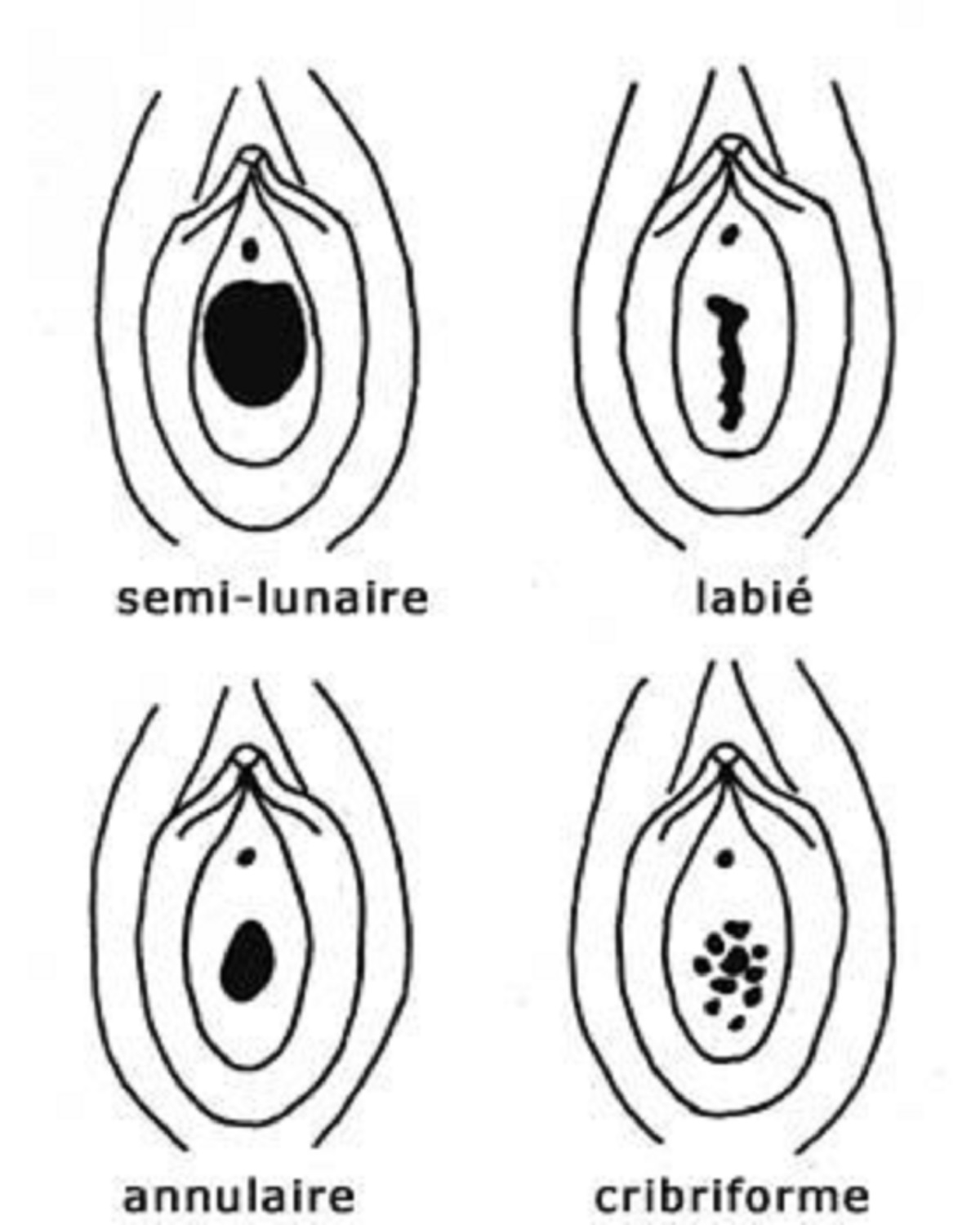 les formes d'hymen de la femme