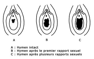 schéma des différentes tailles d'hymen