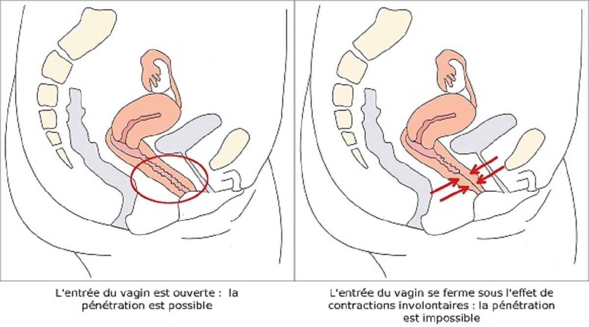 schéma montrant la manifestation physique du vaginisme