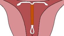 illustration d'un stérilet à l'intérieur de la cavité utérine