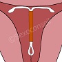 schema sterilet dans uterus