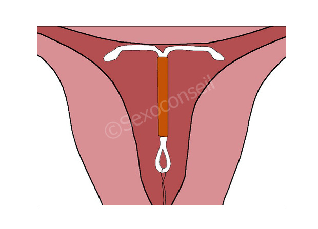 schéma stérilet cuivre dans l'utérus
